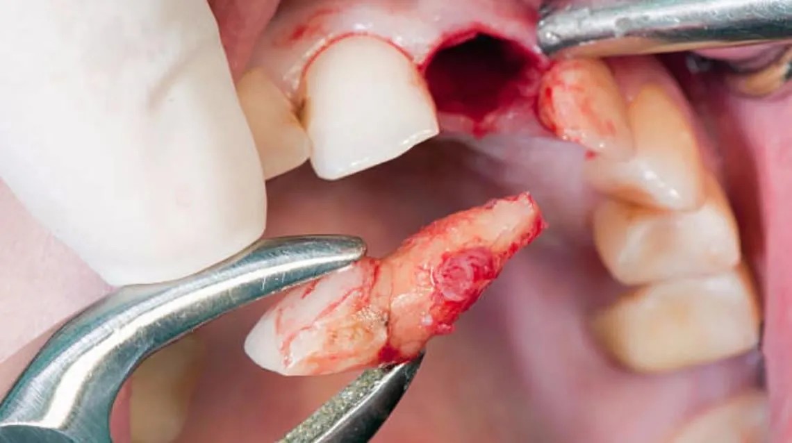 Tooth extraction treatment in Kharadi , Wadgaon Sheri image 1