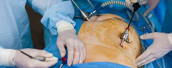 Fertility Enhancing Endoscopic Surgeries image 1