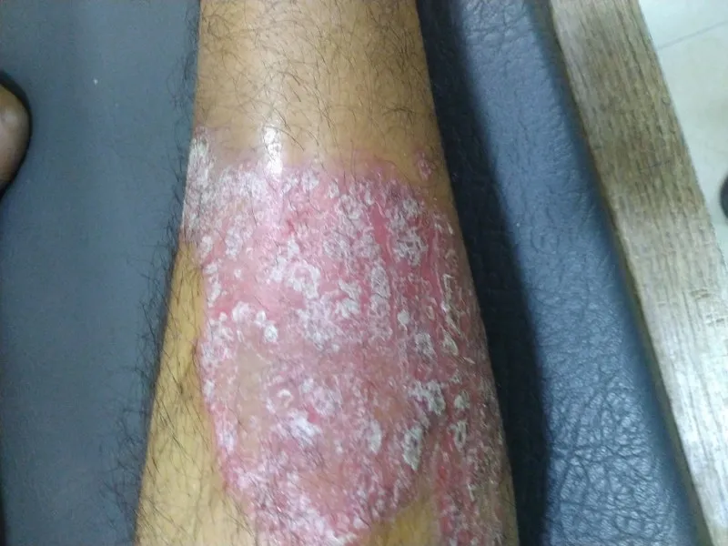 Psoriasis Care  image 1