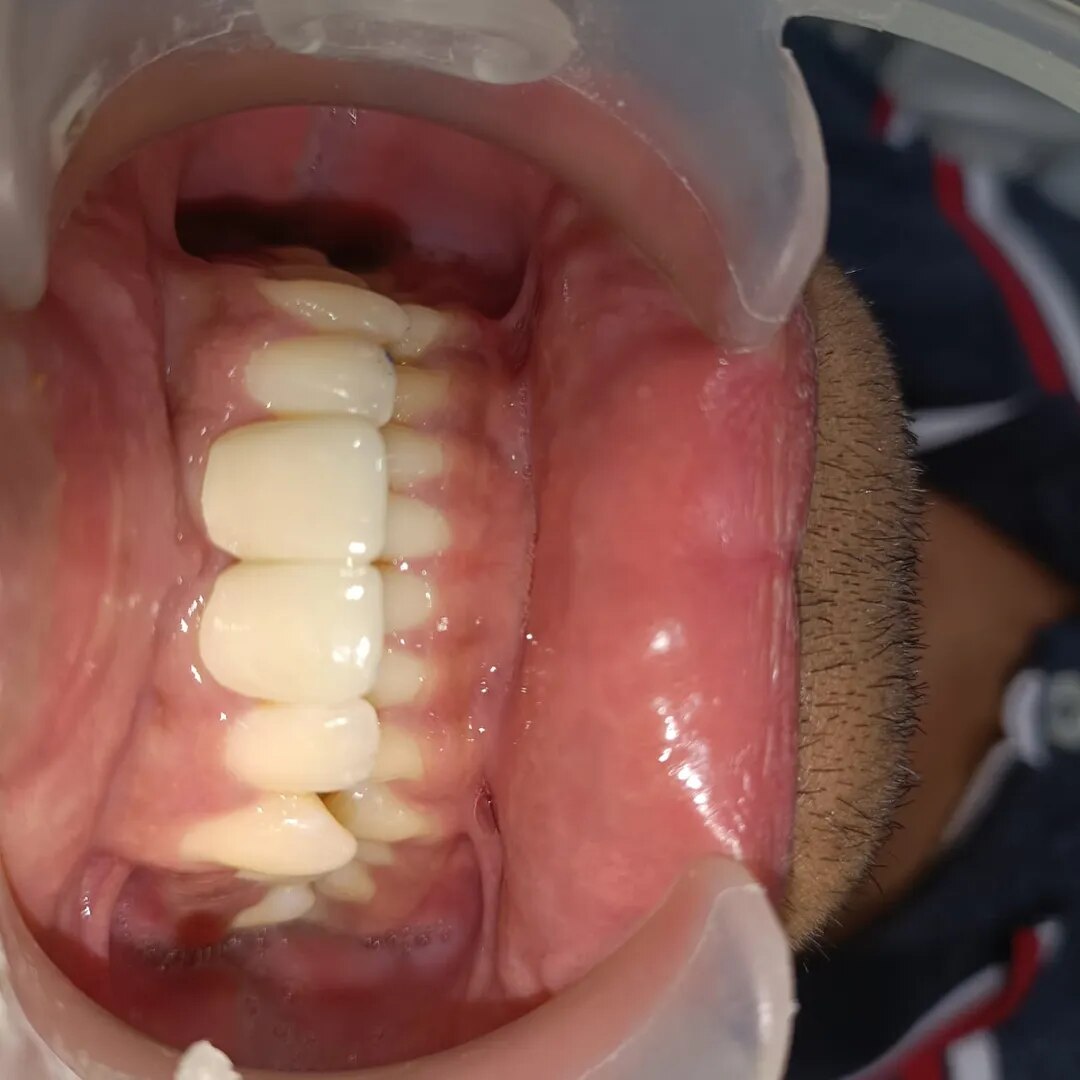 Zirconia Crown  image 1