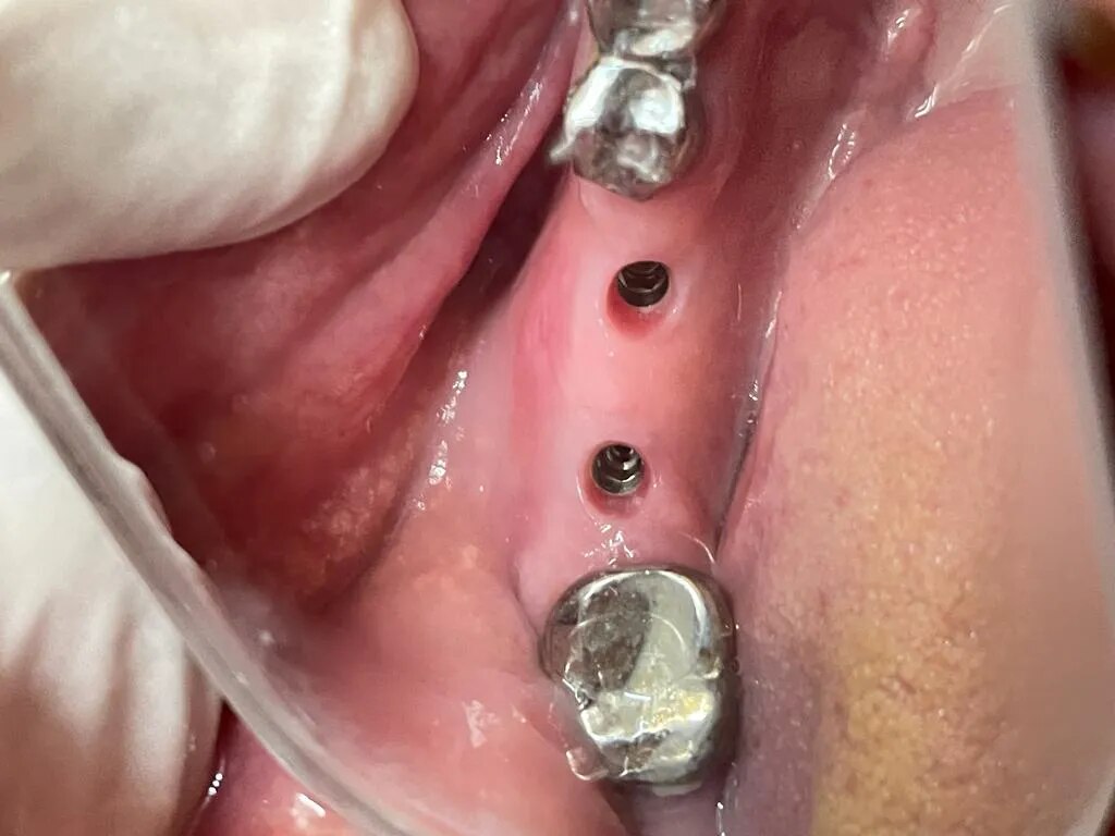 Tooth Implant treatment in Kharadi , Wadgaon Sheri image 1