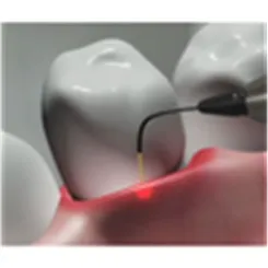 Dental Laser image 1