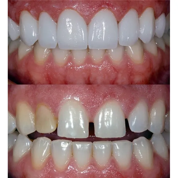 Porcelain veneers and crowns image 1