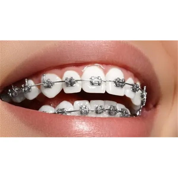 Fixed braces image 1