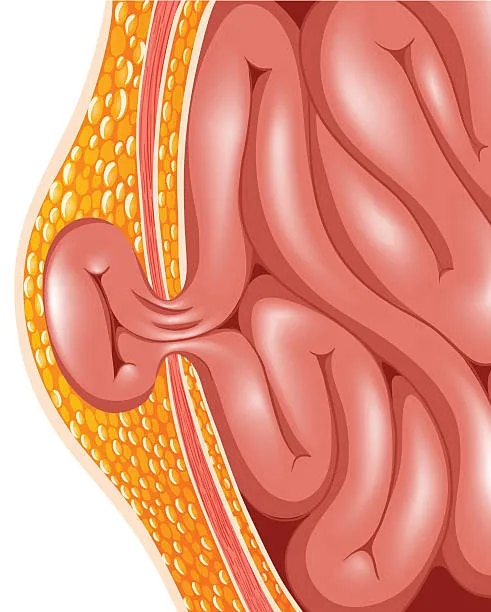 Inguinal Hernia image 1