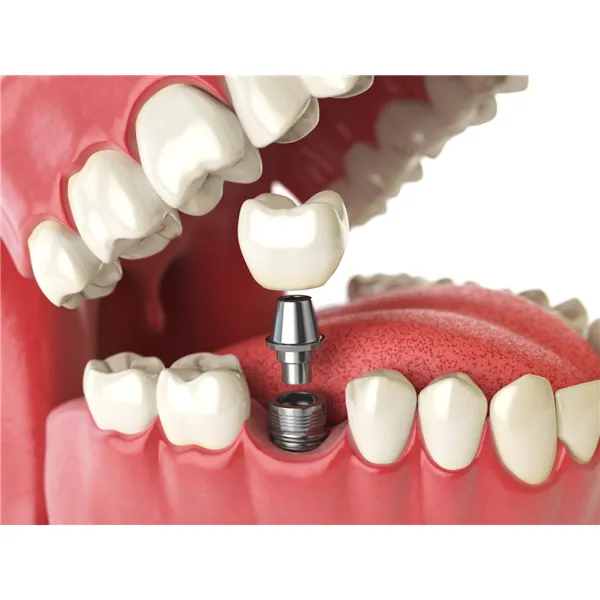 Single tooth Implants image 1