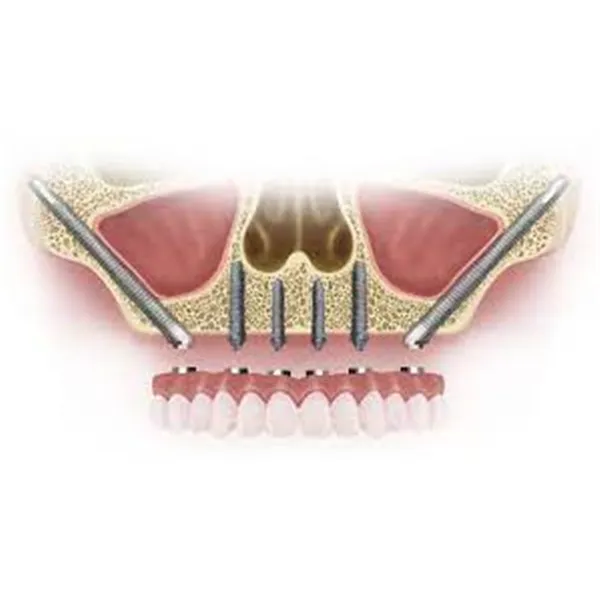 Zygomatic Implants image 1