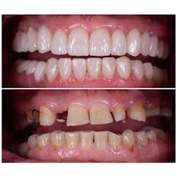Full mouth rehabilitations image 1