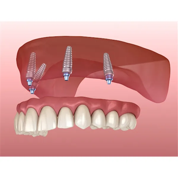 Implant supported dentures image 1