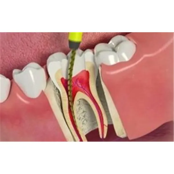 Root canal treatments (RCT) image 1