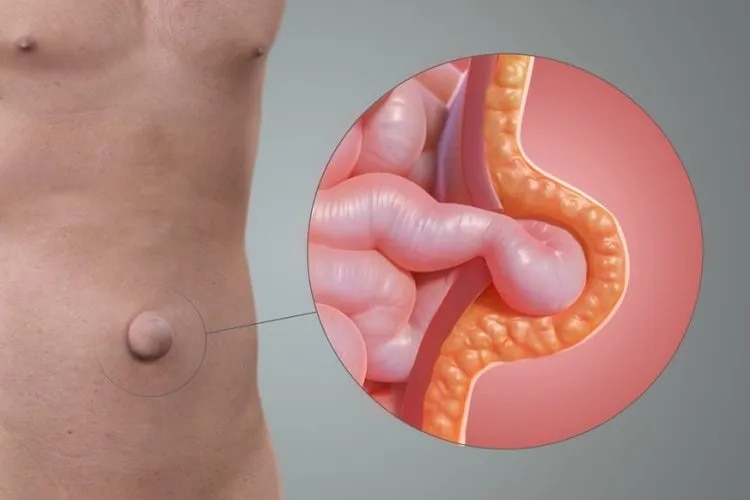Umbilical Hernia image 1