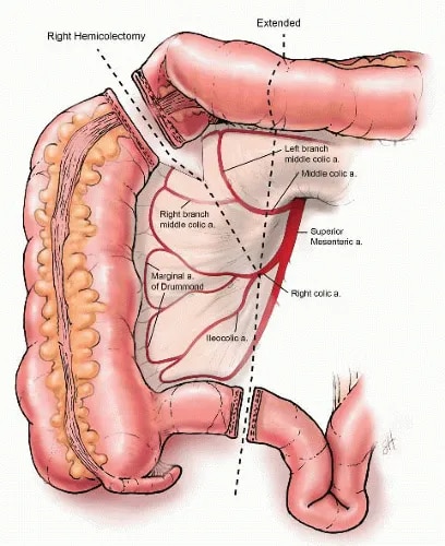 Right Hemicolectomy image 1