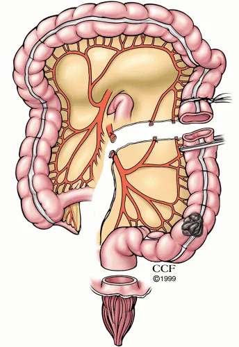 Left Hemicolectomy image 1