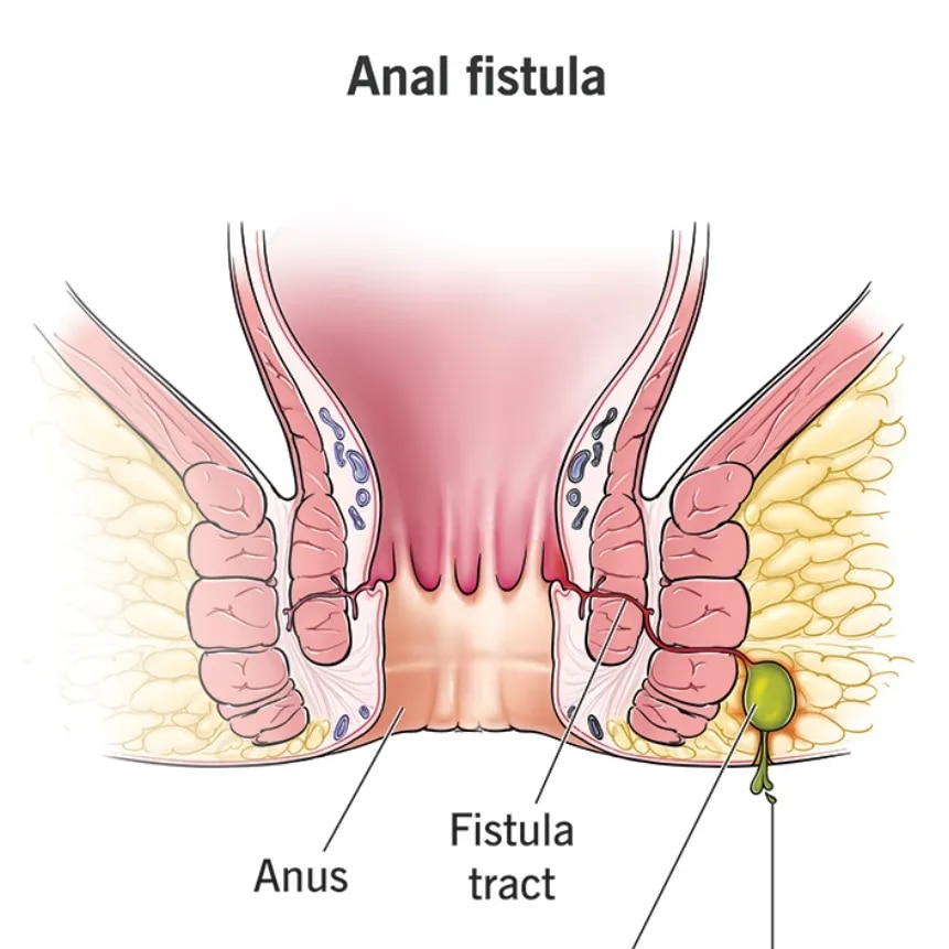 Fistula in Ano image 1