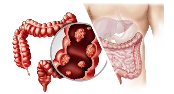 Colorectal Cancer Surgeon in Mahim,Mumbai image 1