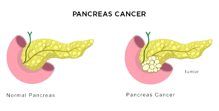 Hepatobiliary Pancreatic Cancer Surgeon in Mahim,Mumbai image 1