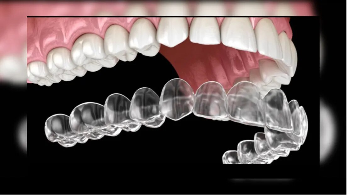 Invisalign Clear Aligners image 1