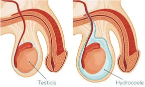 Testicular Swelling Surgery  image 1