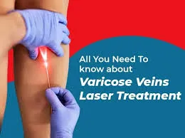 laser Varicose Vein Surgery image 1