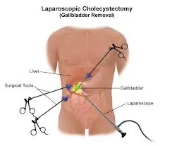 Gallstones laparoscopic Surgery image 1
