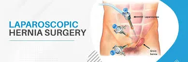 Hernia Surgery image 1