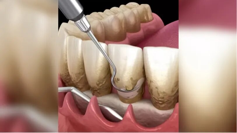 Flap Surgery image 1