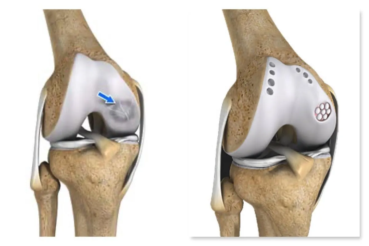 Joint Preservation Surgery In Dadar image 1