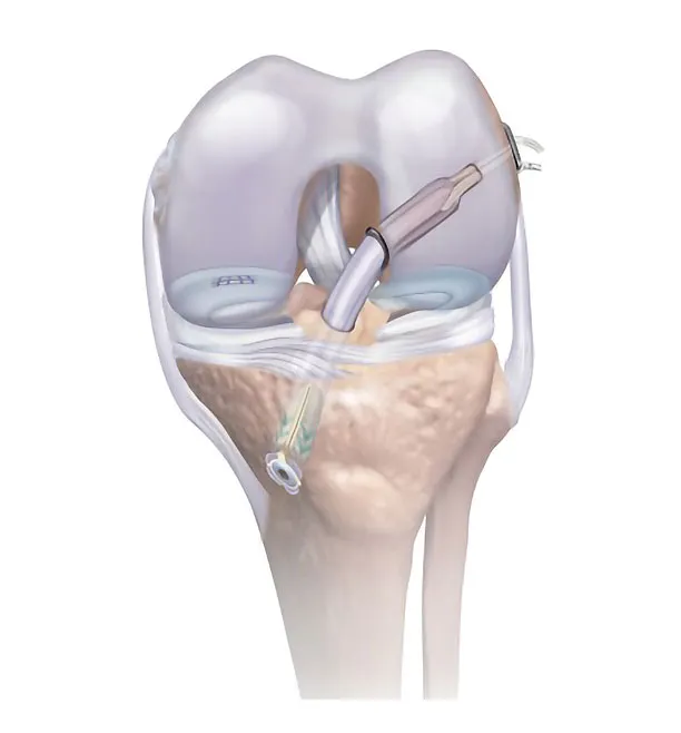 Knee Surgery In Dadar image 1