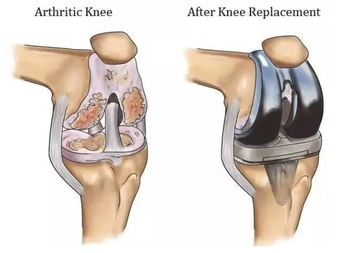 Replacement (Arthroplasty) In Dadar image 1