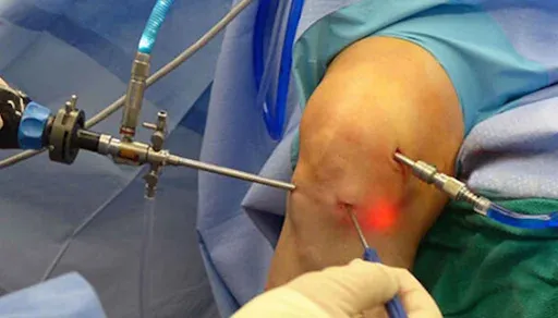 Arthroscopy In Dadar image 1