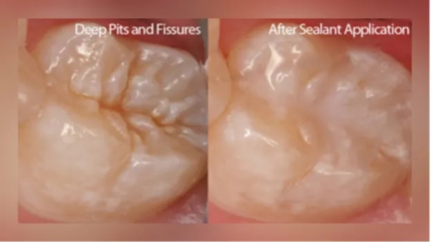 Pit and Fissure Sealants image 1