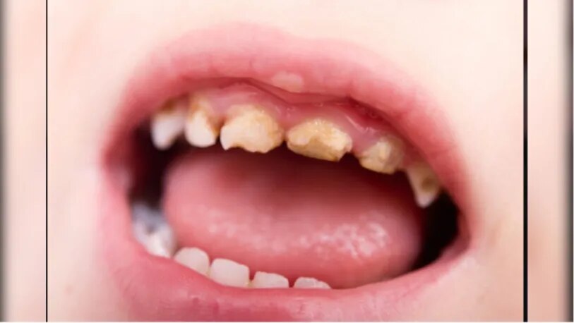 Caries in milk teeth image 1