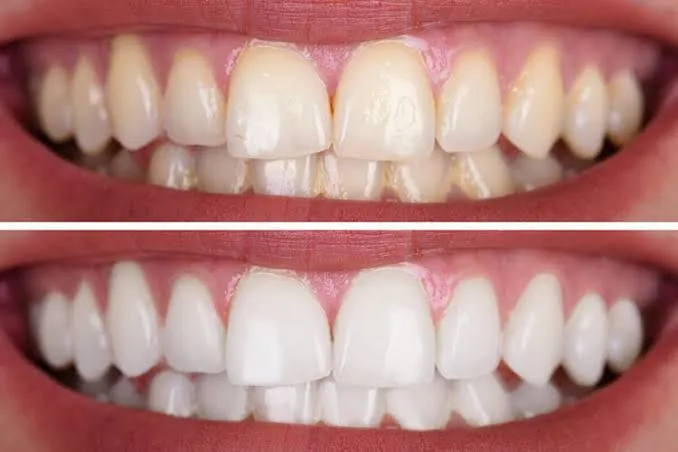 Teeth whitening image 1