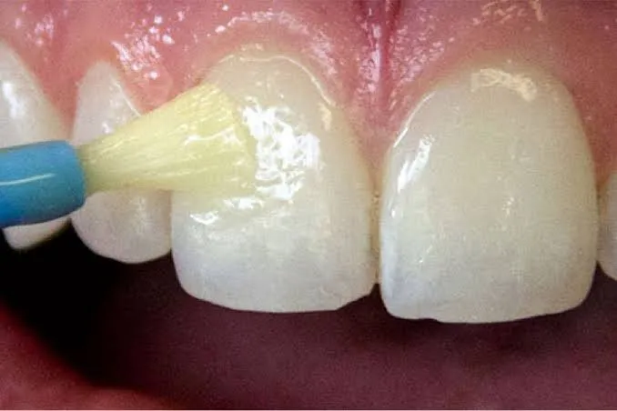 Fluoride Application image 1