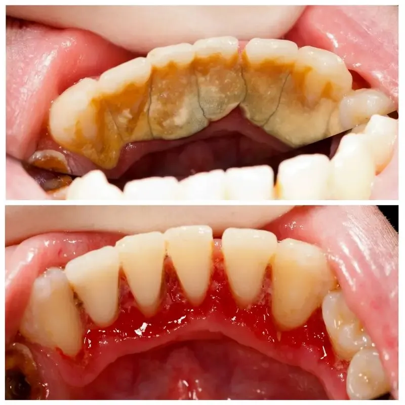 Cleaning teeth image 1