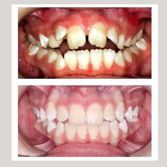Allignment of teeth image 1