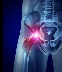 Hip Arthritis & treatment image 1