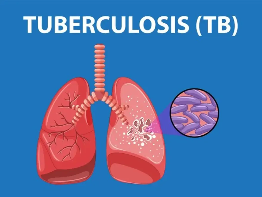 Tuberculosis (TB) Diagnosis & Treatment image 1