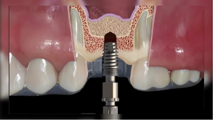 Indirect Sinus Lift Surgery image 1