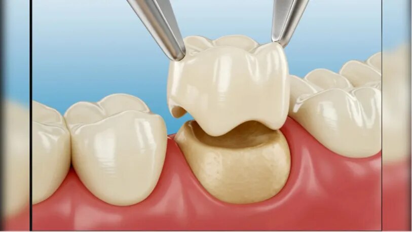 Zirconia Crowns image 1