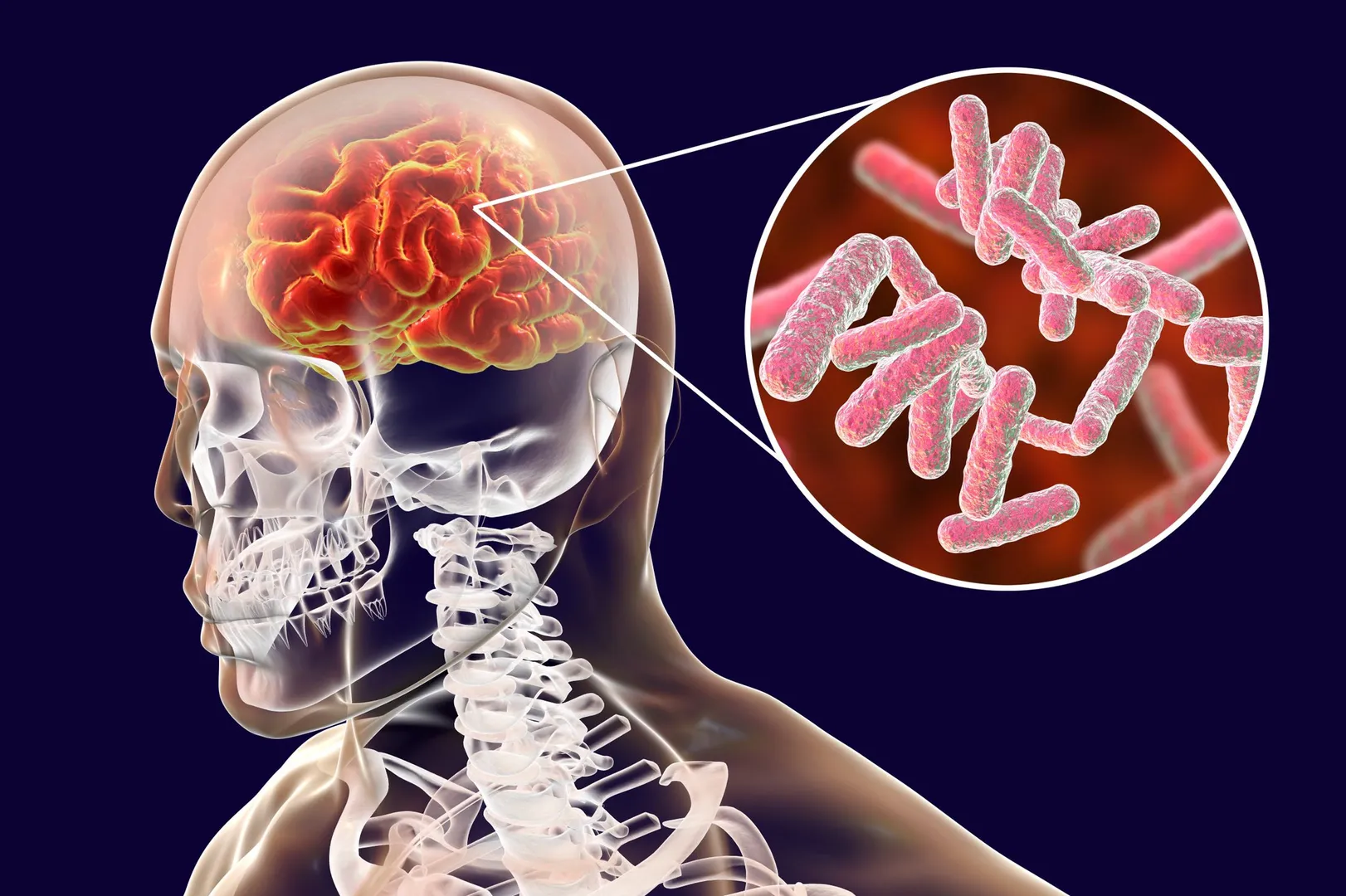 Brain Infection Treatment image 1