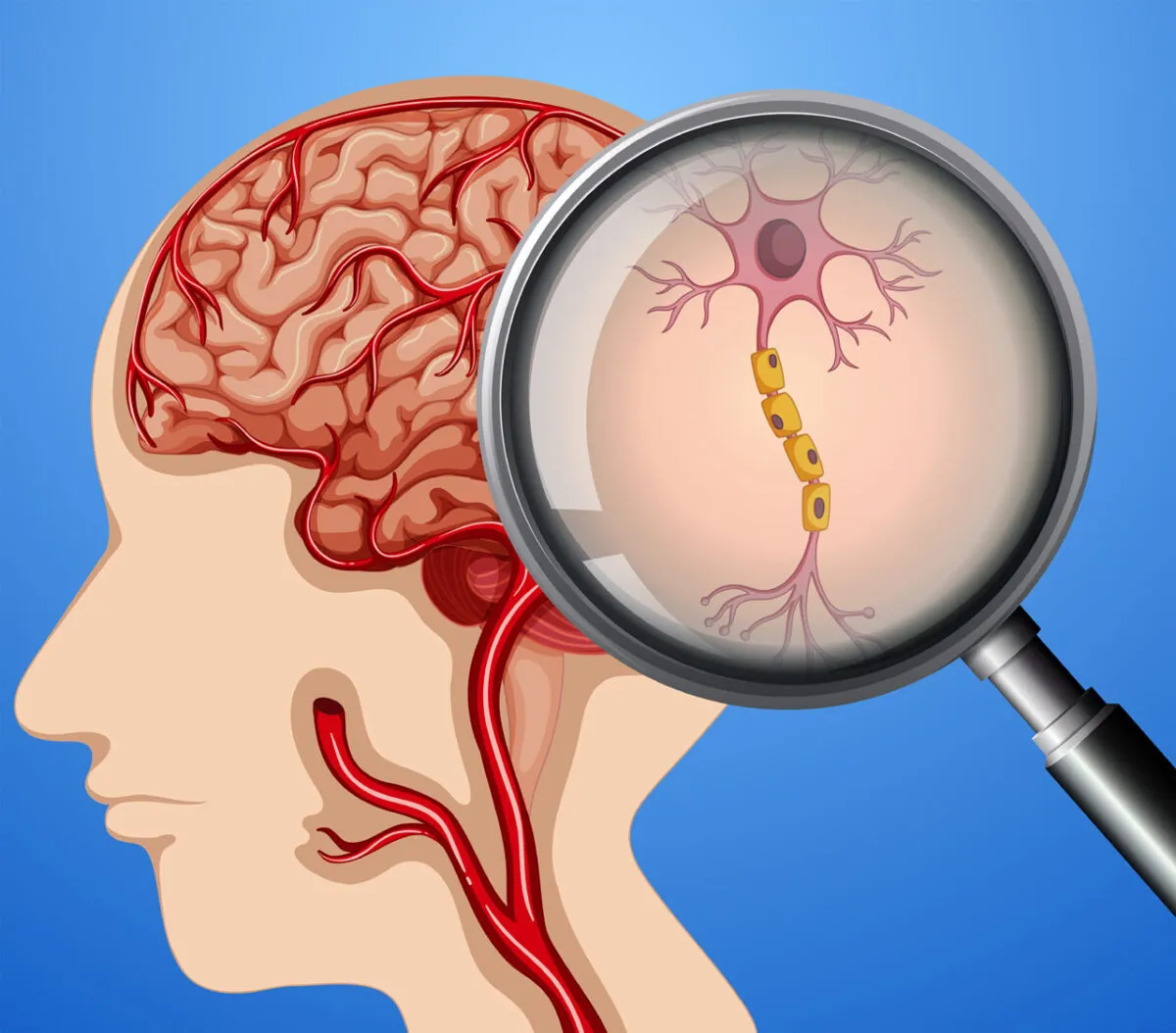 Brain Hemorrhage Treatment image 1