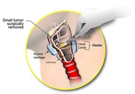 Best Micro Laryngeal Surgery Specialist in Bavdhan,Pune & PCMC image 1