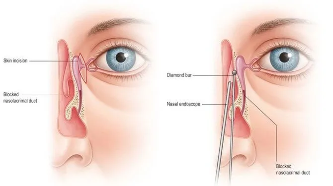 Endoscopic DCR Surgery Specialist in Bavdhan, Kothrud,Pune, PCMC  image 1