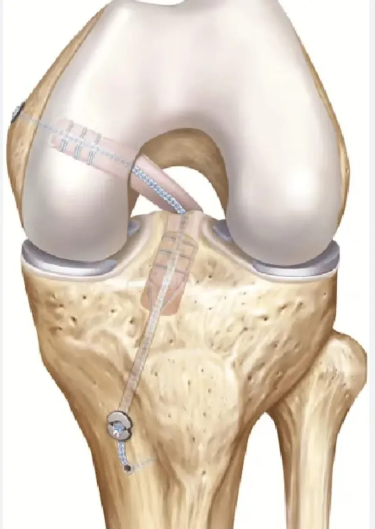 PCL Repair Surgery image 1