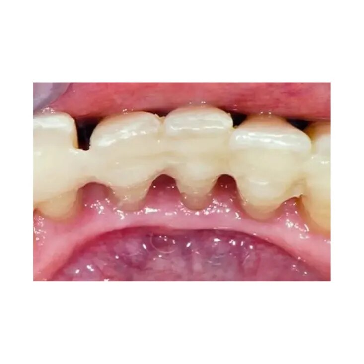 Splinting of Loose Teeth image 1