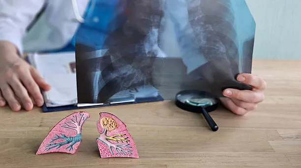 Chronic Cough Evaluation image 1