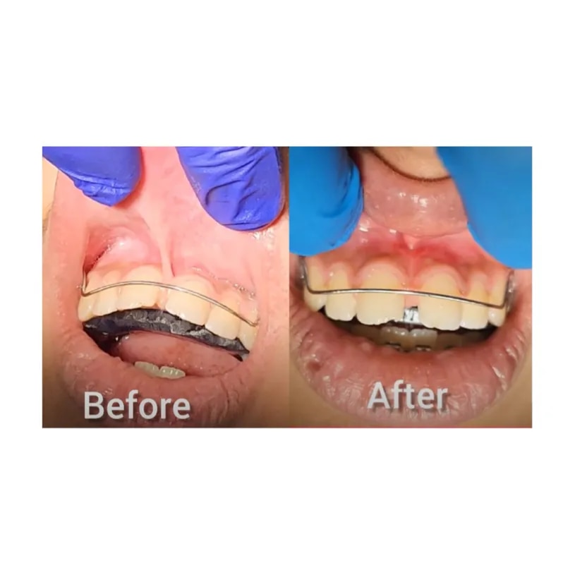 Laser Frenectomy  image 1