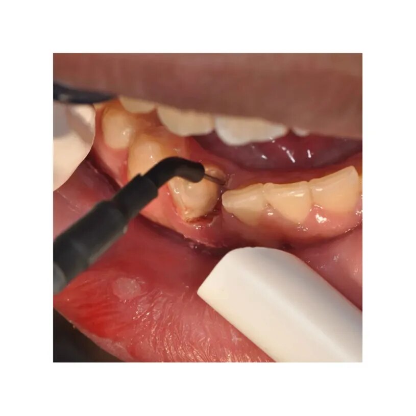 Electrocautery image 1
