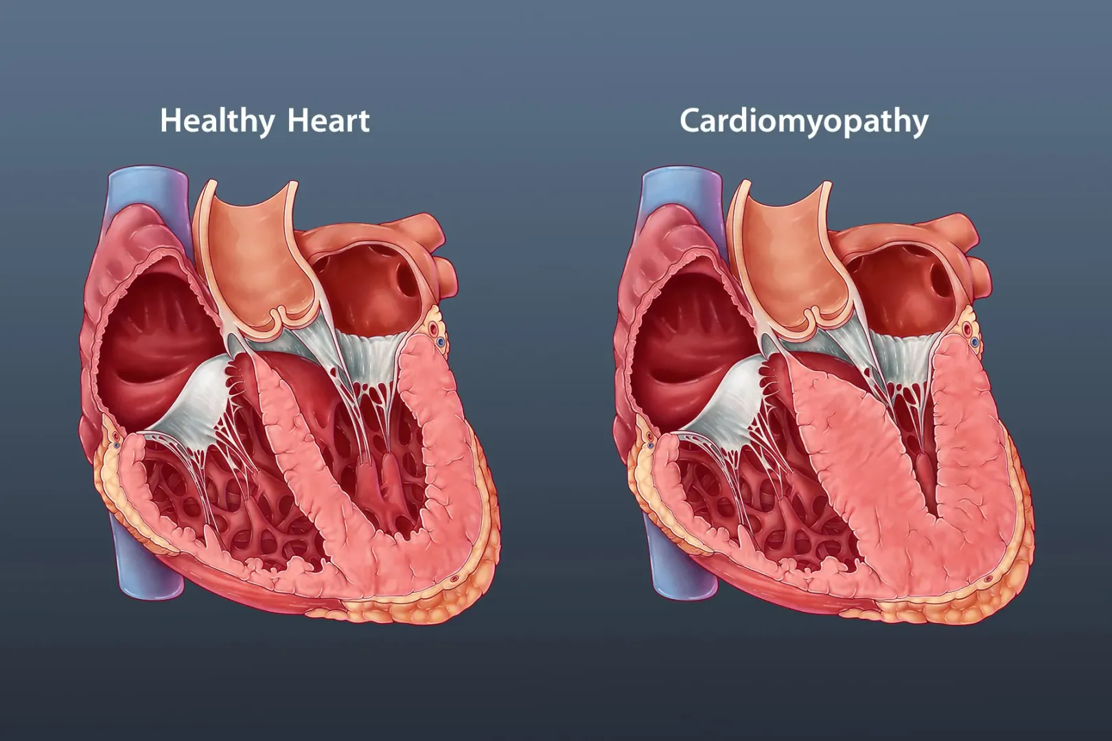 Cardiomyopathy Treatment image 1